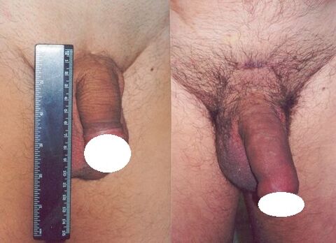 Penis przed i po wzroście