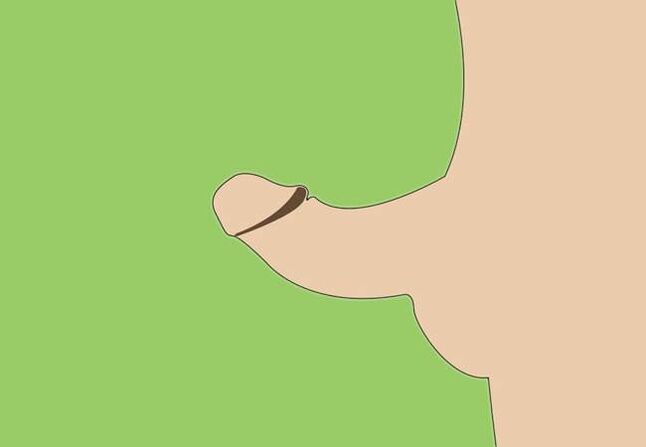 skrzywienie prącia jako wskazanie do chirurgicznego powiększenia